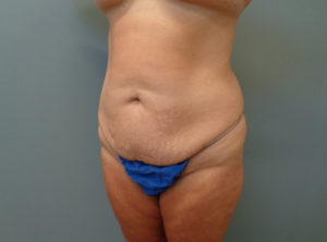 TUMMY TUCK BEFORE & AFTER PICTURES IN NASHVILLE, TN