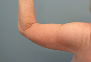 Arm Lift Before & After Pictures in Nashville, TN