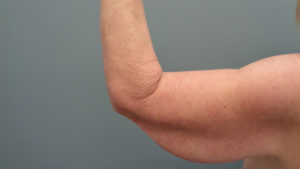 Arm Lift Before and After Pictures Nashville, TN