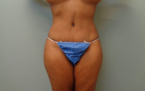 Tummy Tuck Before & After Pictures Nashville, TN