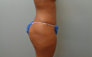 Tummy Tuck Before & After Pictures Nashville, TN