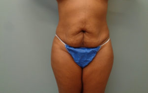 Tummy Tuck Before & After Pictures Nashville, TN