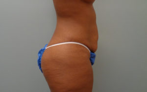 Tummy Tuck Before & After Pictures Nashville, TN