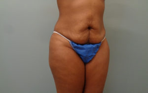 Tummy Tuck Before & After Pictures Nashville, TN