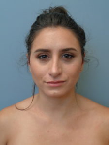 RHINOPLASTY BEFORE & AFTER PICTURES IN NASHVILLE, TN