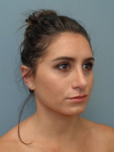 Rhinoplasty Before & After Pictures in Nashville, TN