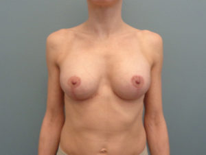 Breast Augmentation with Lift Before & After Pictures in Nashville, TN