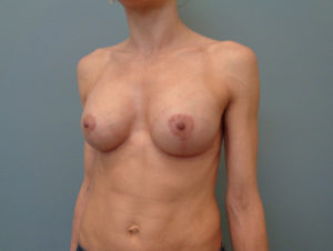 Breast Augmentation with Lift Before & After Pictures in Nashville, TN