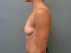 Breast Augmentation with Lift Before & After Pictures in Nashville, TN