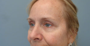 Blepharoplasty Before & After Pictures in Nashville, TN