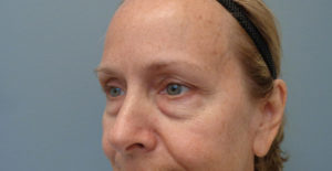 Blepharoplasty Before & After Pictures in Nashville, TN