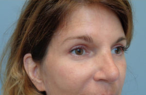 Blepharoplasty Before & After Pictures in Nashville, TN