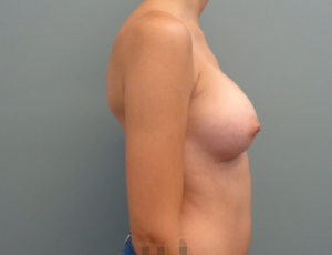 Breast Augmentation Before & After Pictures in Nashville, TN