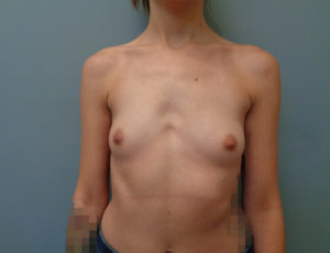 Breast Augmentation Before & After Pictures in Nashville, TN