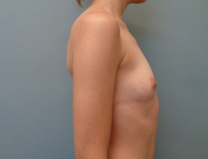 Breast Augmentation Before & After Pictures in Nashville, TN