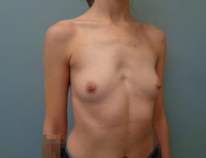 Breast Augmentation Before & After Pictures in Nashville, TN