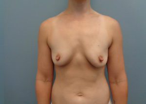 Breast Augmentation Before & After Pictures in Nashville, TN