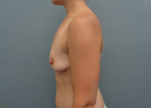 Breast Augmentation Before & After Pictures in Nashville, TN