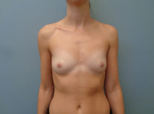 Breast Augmentation Before & After Pictures in Nashville, TN