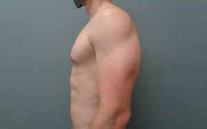 Gynecomastia Before & After Pictures in Nashville, TN