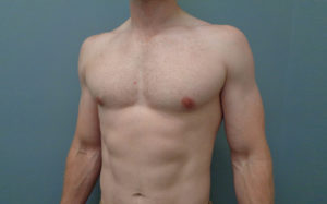 Gynecomastia Before & After Pictures in Nashville, TN