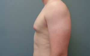 Gynecomastia Before and After Pictures Nashville, TN