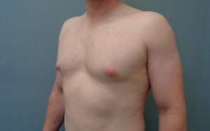 Gynecomastia Before and After Pictures Nashville, TN