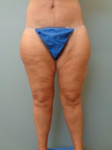 Thigh Lift Before and After Pictures Nashville, TN