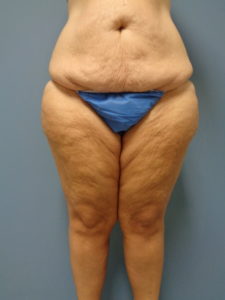 Thigh Lift Before and After Pictures Nashville, TN