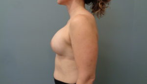 Breast Augmentation Before and After Pictures Nashville, TN