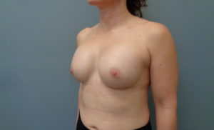 Breast Augmentation Before and After Pictures Nashville, TN