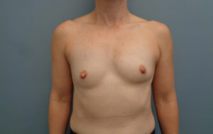 Breast Augmentation Before and After Pictures Nashville, TN