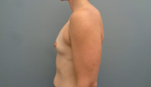 Breast Augmentation Before and After Pictures Nashville, TN