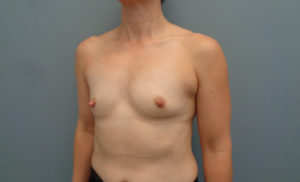 Breast Augmentation Before and After Pictures Nashville, TN