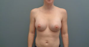 Breast Augmentation Before and After Pictures Nashville, TN