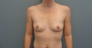 Breast Augmentation Before and After Pictures Nashville, TN