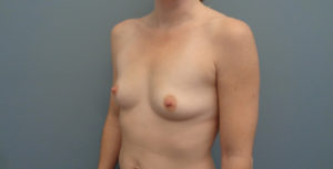 Breast Augmentation Before and After Pictures Nashville, TN