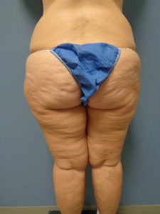 Thigh Lift Before and After Pictures Nashville, TN