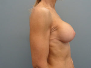 Implant Exchange Before & After Pictures in Nashville, TN