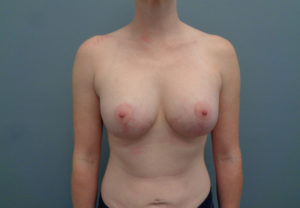 Breast Augmentation with Lift Before & After Pictures in Nashville, TN