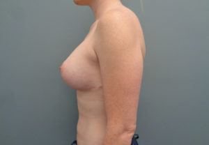 Breast Augmentation with Lift Before & After Pictures in Nashville, TN