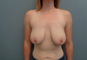 Breast Augmentation with Lift Before & After Pictures in Nashville, TN