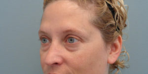 Blepharoplasty Before & After Pictures in Nashville, TN