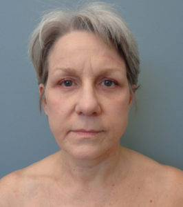 Facelift Before & After Pictures in Nashville, TN