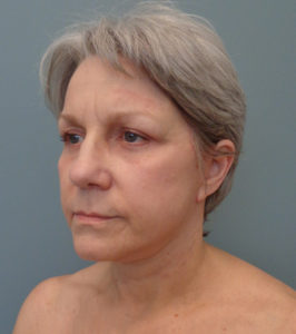 Facelift Before & After Pictures in Nashville, TN