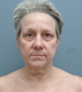 Facelift Before & After Pictures in Nashville, TN