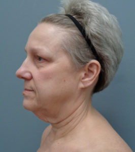 Facelift Before & After Pictures in Nashville, TN