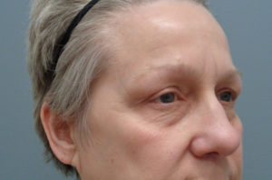 Blepharoplasty Before & After Pictures in Nashville, TN