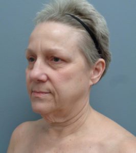 Facelift Before & After Pictures in Nashville, TN