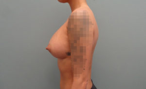 Breast Augmentation Before & After Pictures in Nashville, TN